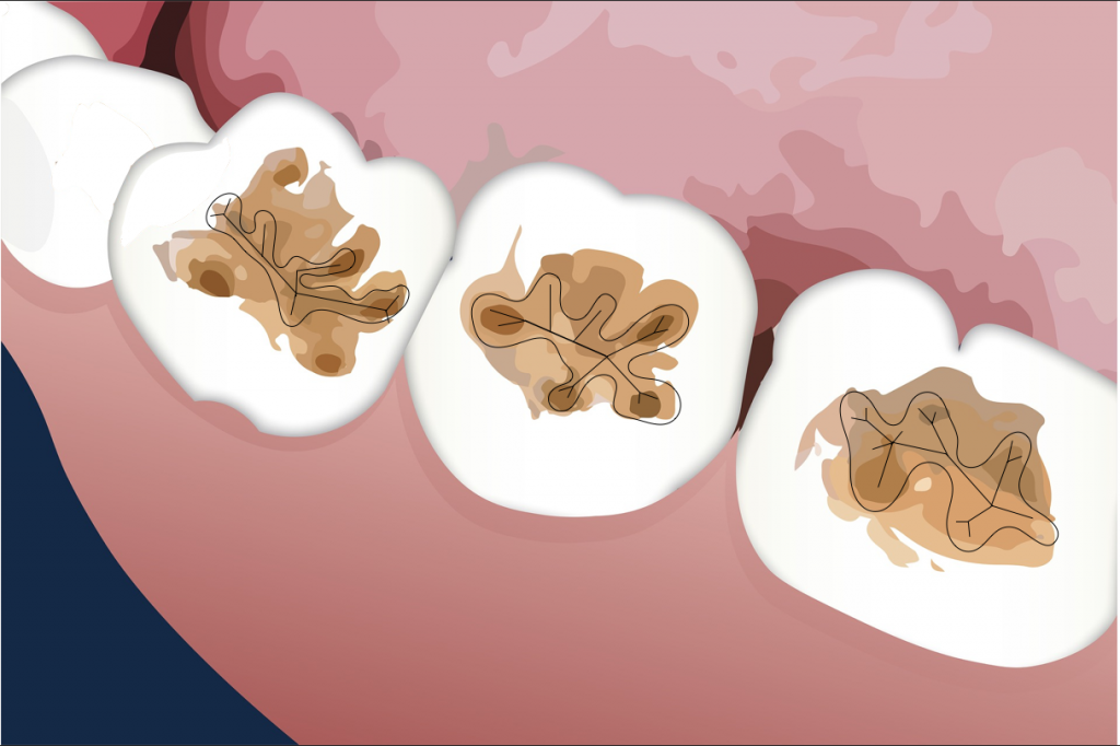 What do dental sealants look like? Berta Furió Alonso